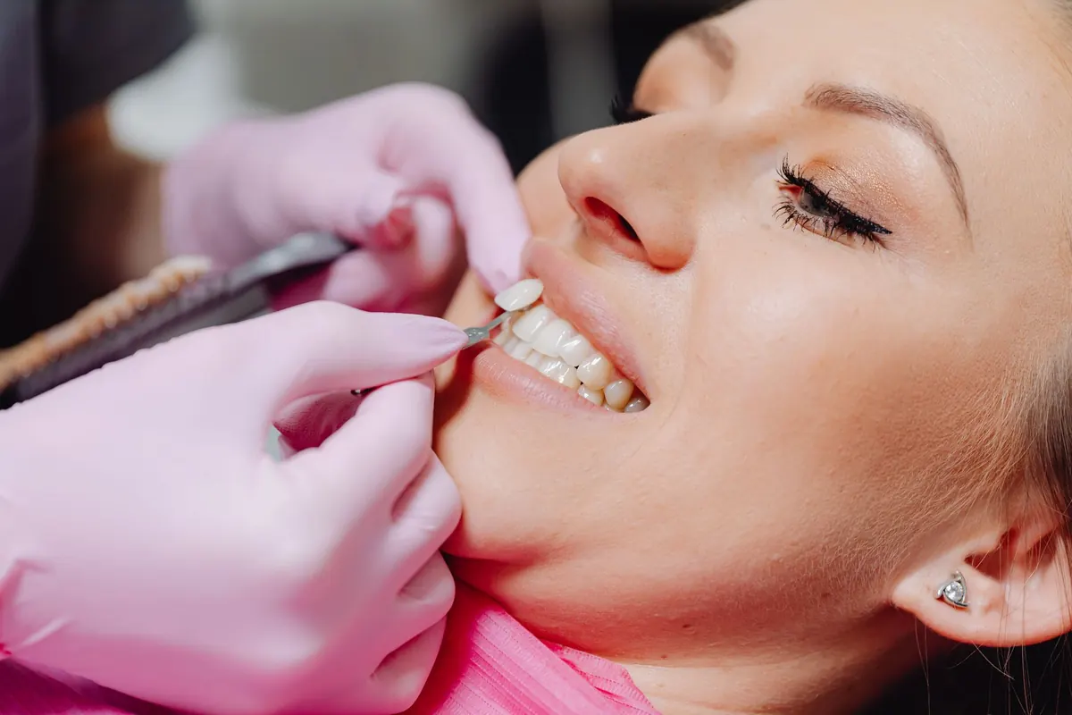 Carillas dentales: la guía honesta antes de transformar tu sonrisa