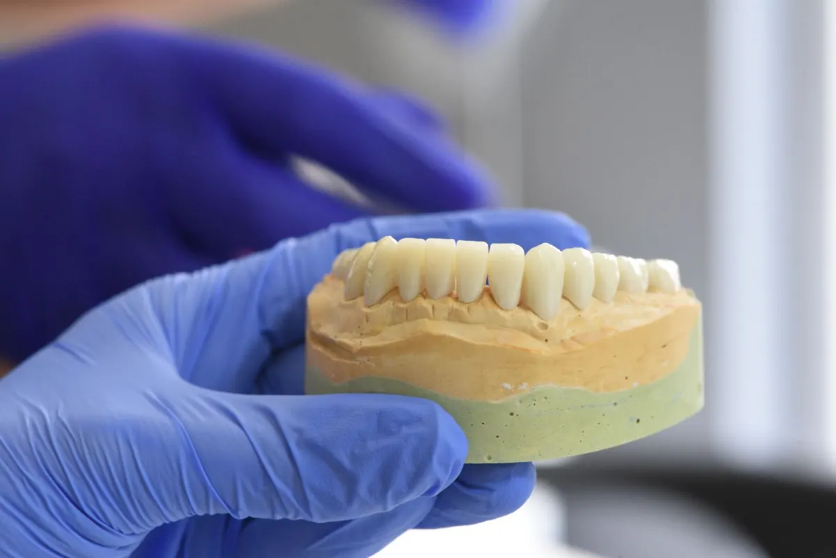 ¿Cuánto dura un implante dental? Lo que depende de ti y lo que no
