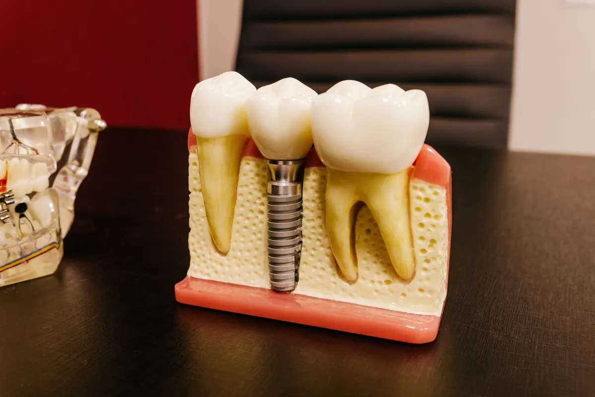 Implante o puente dental: la comparación honesta antes de decidir