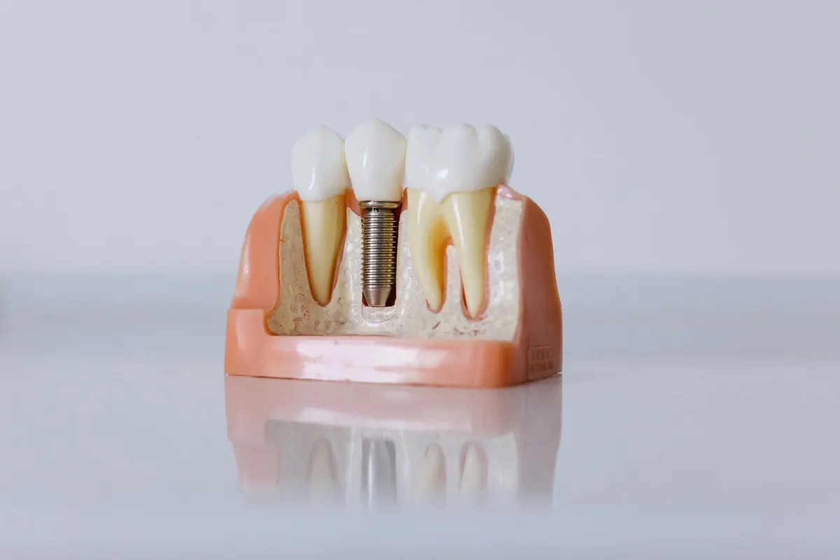 Implantes dentales en Concepción: la guía completa para recuperar tu sonrisa