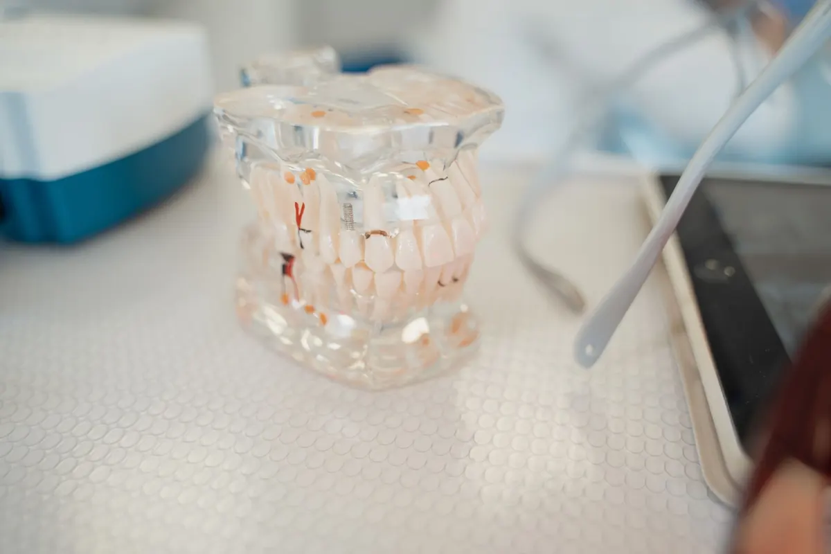 Implantes dentales en el Gran Concepción: guía para Talcahuano, San Pedro, Chiguayante y Hualpén