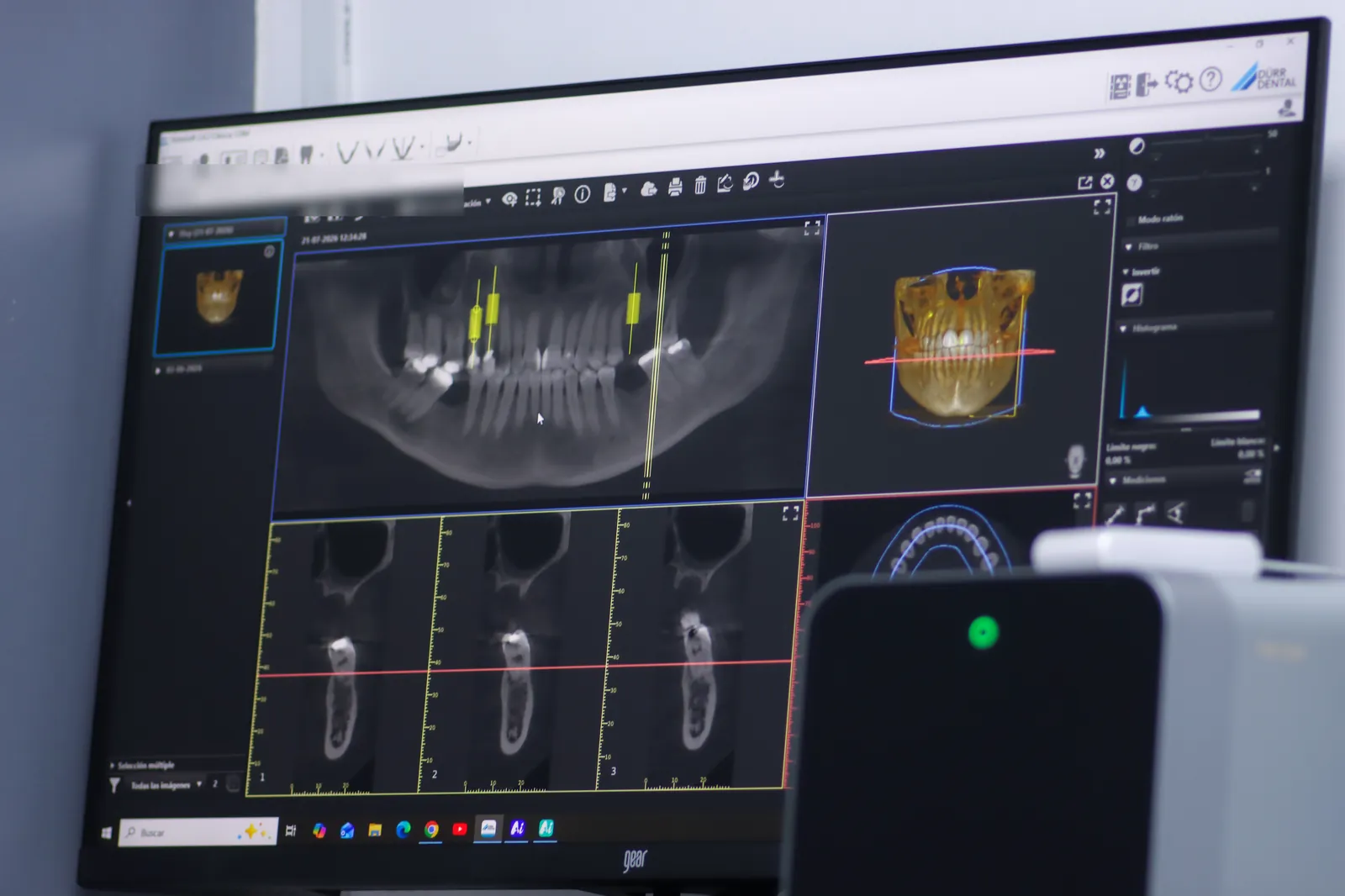 Planificación 3D real de implantes dentales en software DÜRR Dental en CDM Concepción